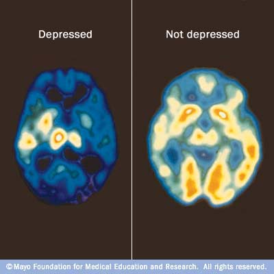 Your brain on and off depression